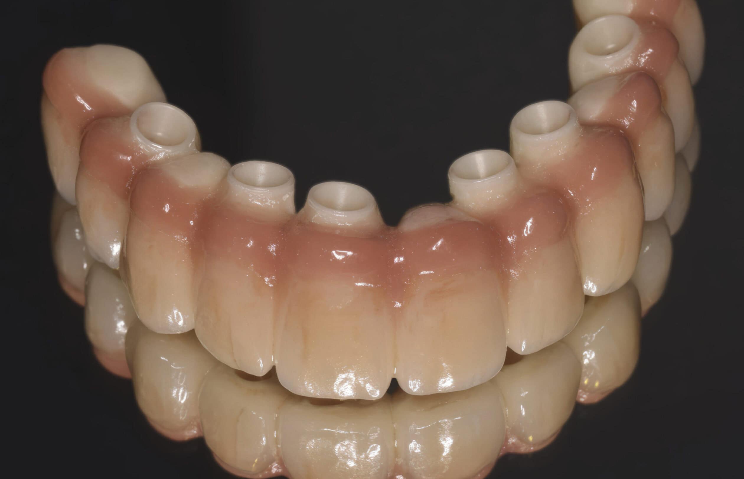 Barre implantaire CFAO en résine avec fausse gencive – Prothèse stabilisée sur implants