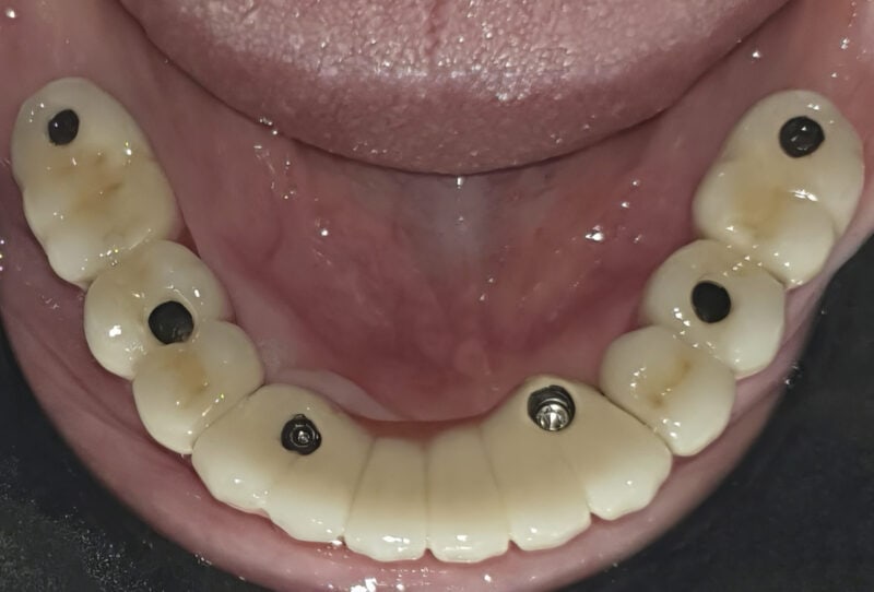 Bridge complet transvissé sur implants multi-unit – accès occlusaux visibles pour vissage:dévissage facile
