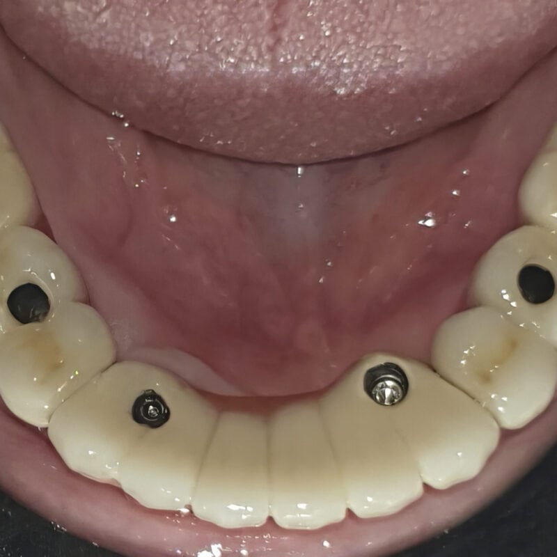 Bridge complet transvissé sur implants multi-unit – accès occlusaux visibles pour vissage:dévissage facile