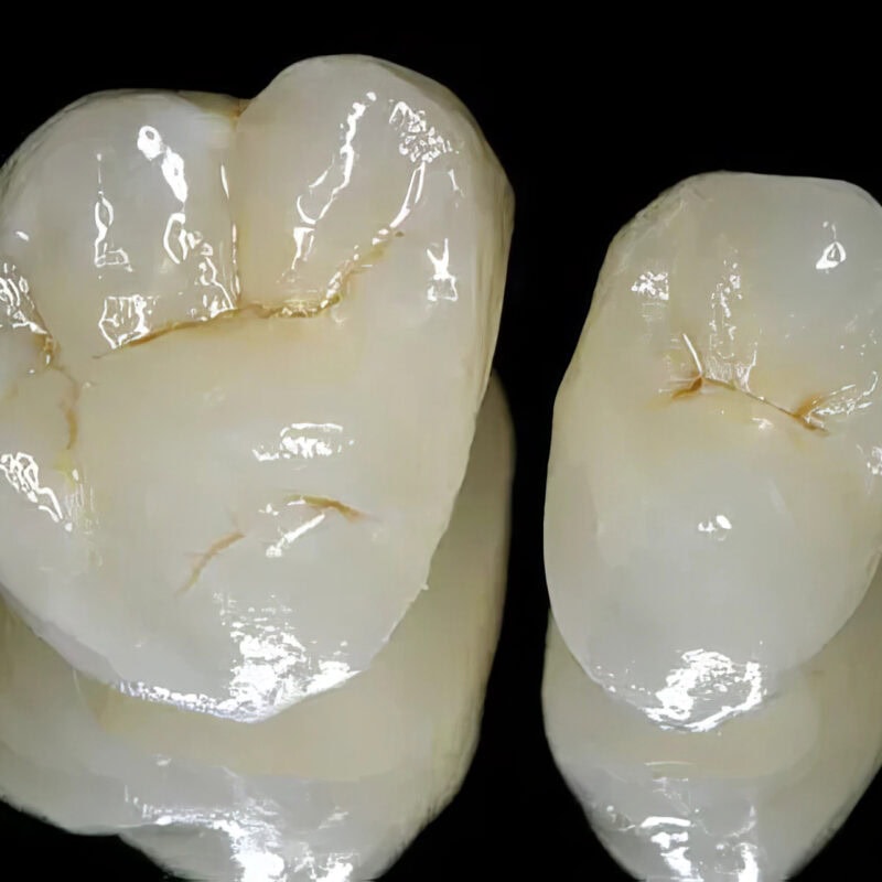 Couronne E-max : Empress – Prothèse dentaire haut de gamme, 100% céramique, pour une restauration esthétique et durable