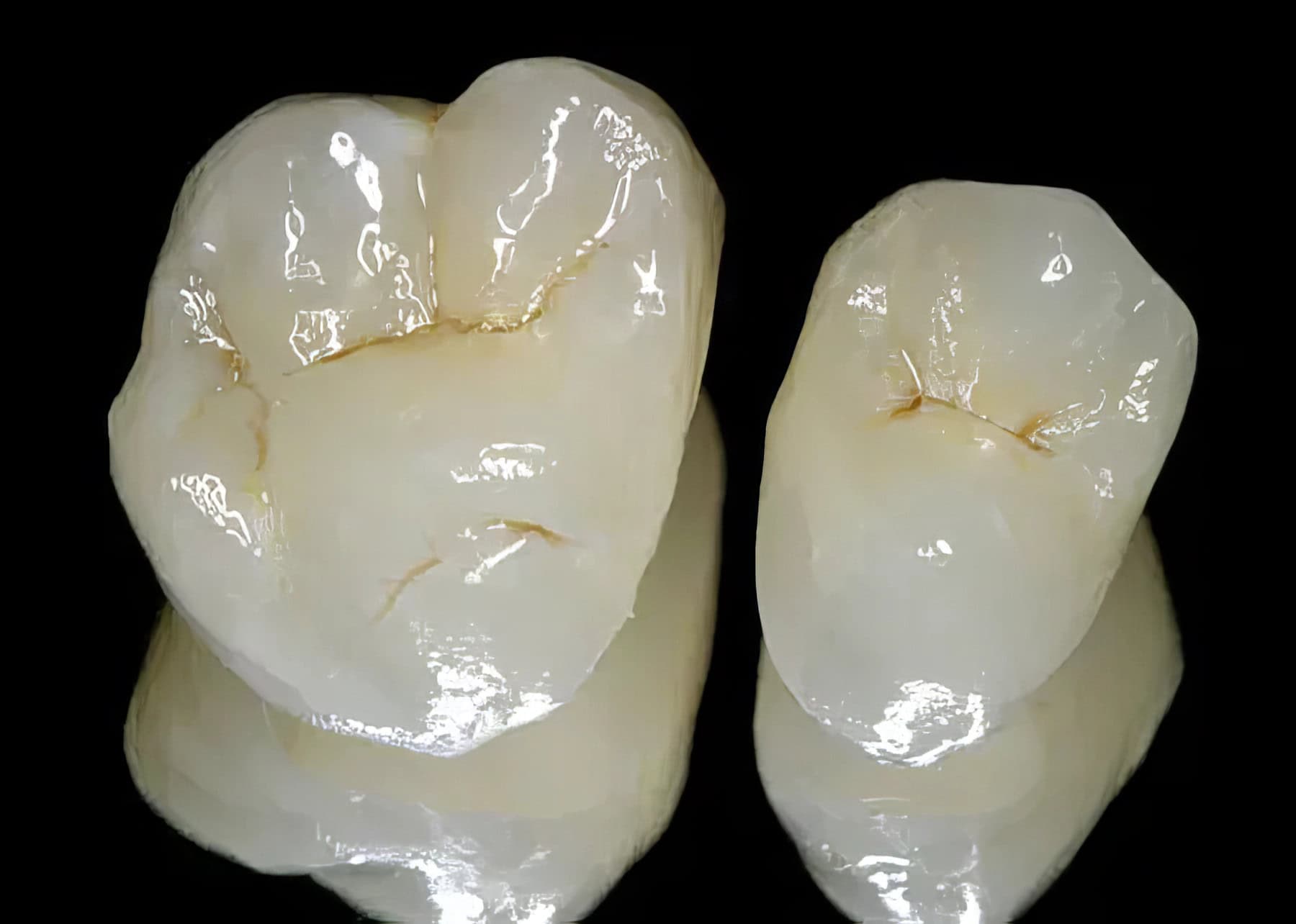 Couronne E-max : Empress – Prothèse dentaire haut de gamme, 100% céramique, pour une restauration esthétique et durable
