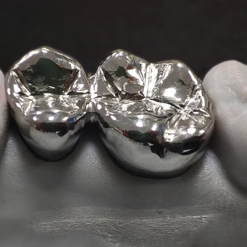 Couronne coulée – Prothèse dentaire fixe économique et robuste pour restaurer durablement les dents endommagées