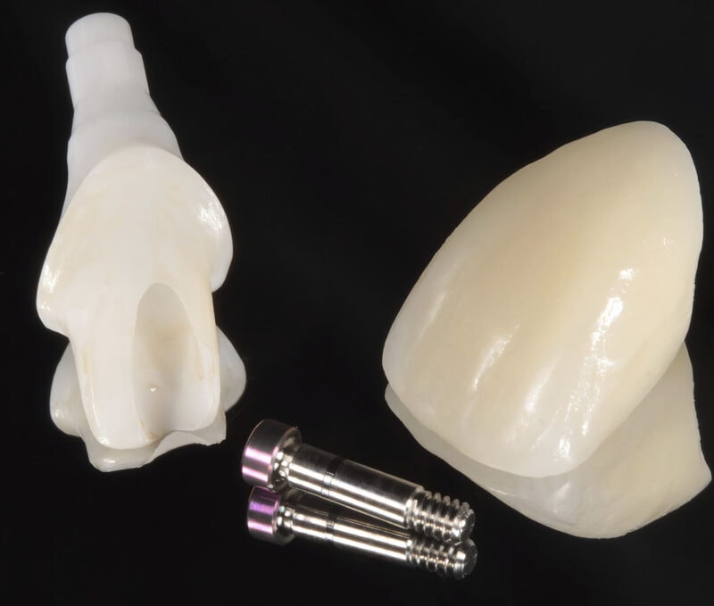 Couronne scellée sur implant avec pilier titane – restauration unitaire esthétique