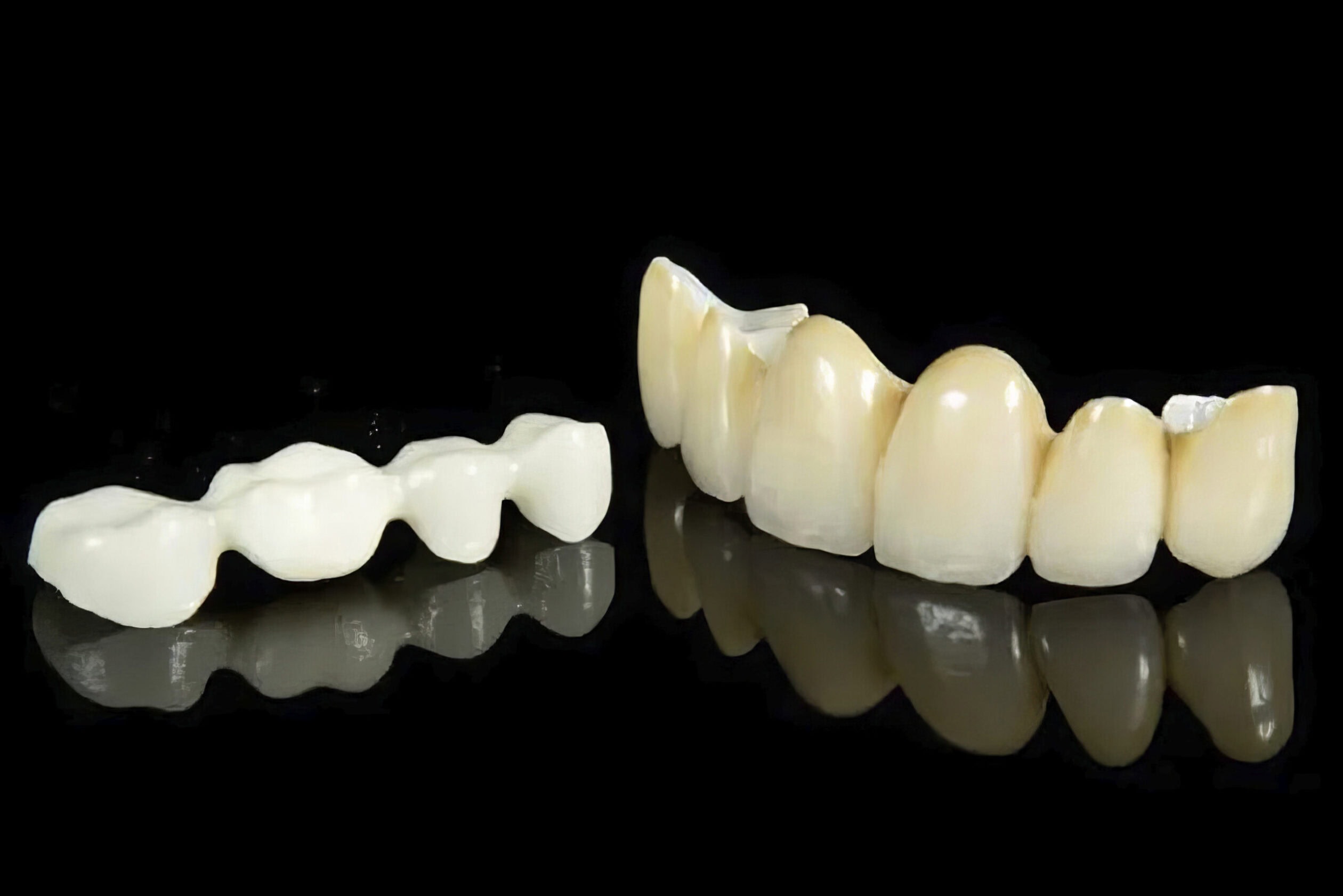 Couronne zircone stratifiée – Prothèse dentaire haut de gamme combinant armature en zircone et stratification céramique pour un rendu naturel et durable 1