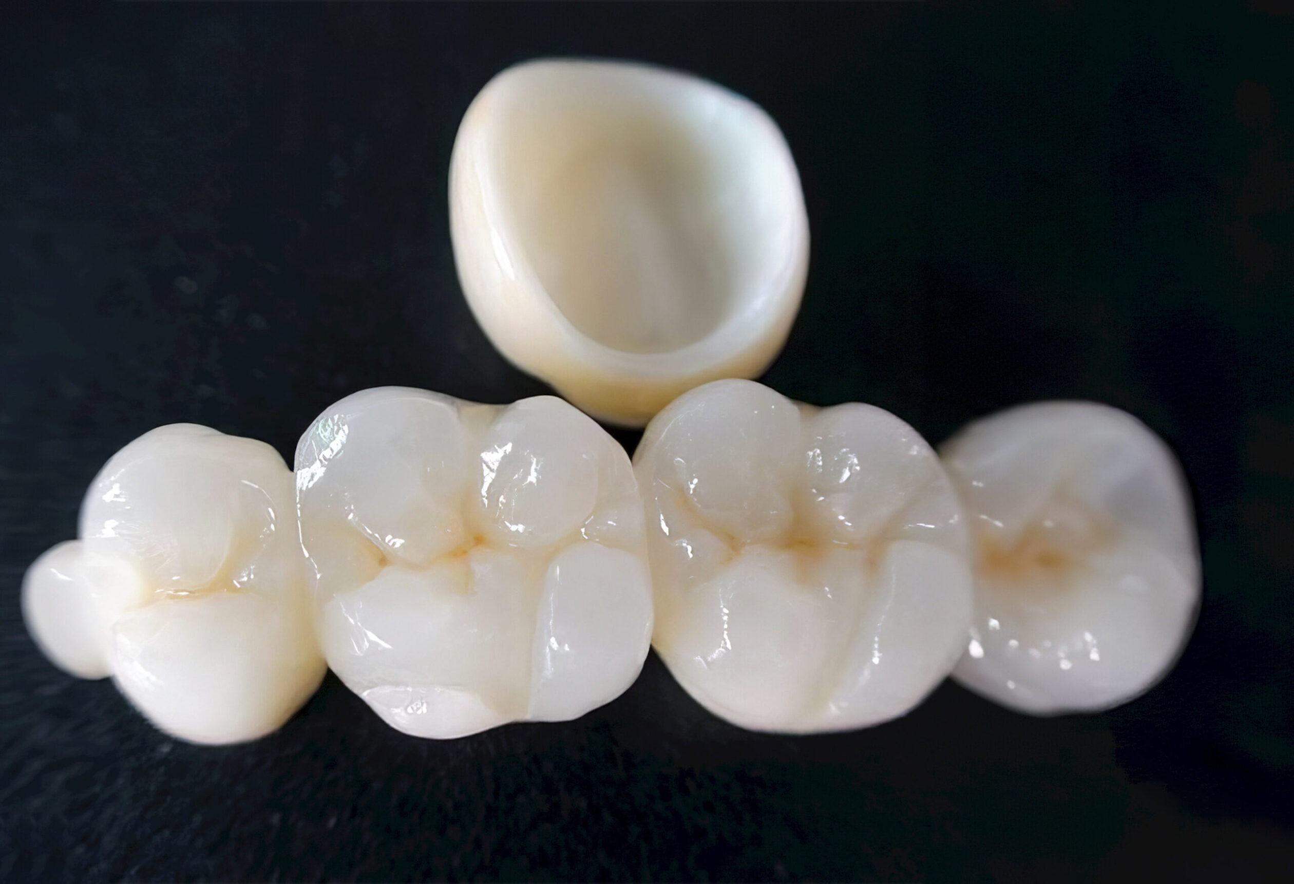 Couronne zircone stratifiée – Prothèse dentaire haut de gamme combinant armature en zircone et stratification céramique pour un rendu naturel et durable 2
