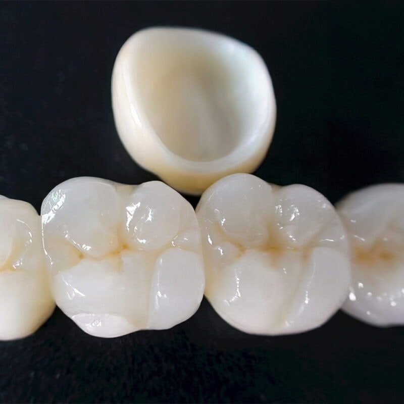 Couronne zircone stratifiée – Prothèse dentaire haut de gamme combinant armature en zircone et stratification céramique pour un rendu naturel et durable 2