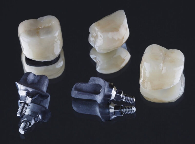 Couronnes dentaires scellées et piliers custom pour implants – ajustement précis et design naturel