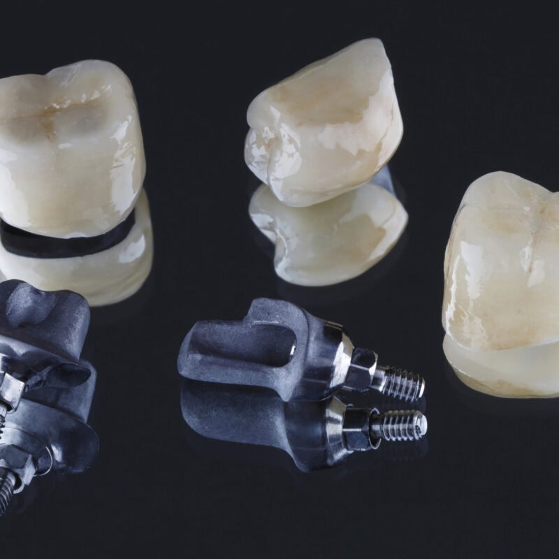Couronnes dentaires scellées et piliers custom pour implants – ajustement précis et design naturel