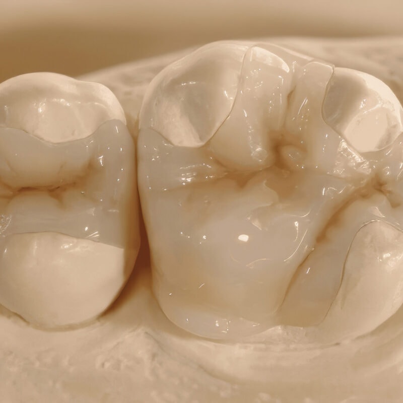 Inlay Onlay composite – Solution esthétique et durable pour restaurer la dentition, alternative moderne aux obturations traditionnelles 2