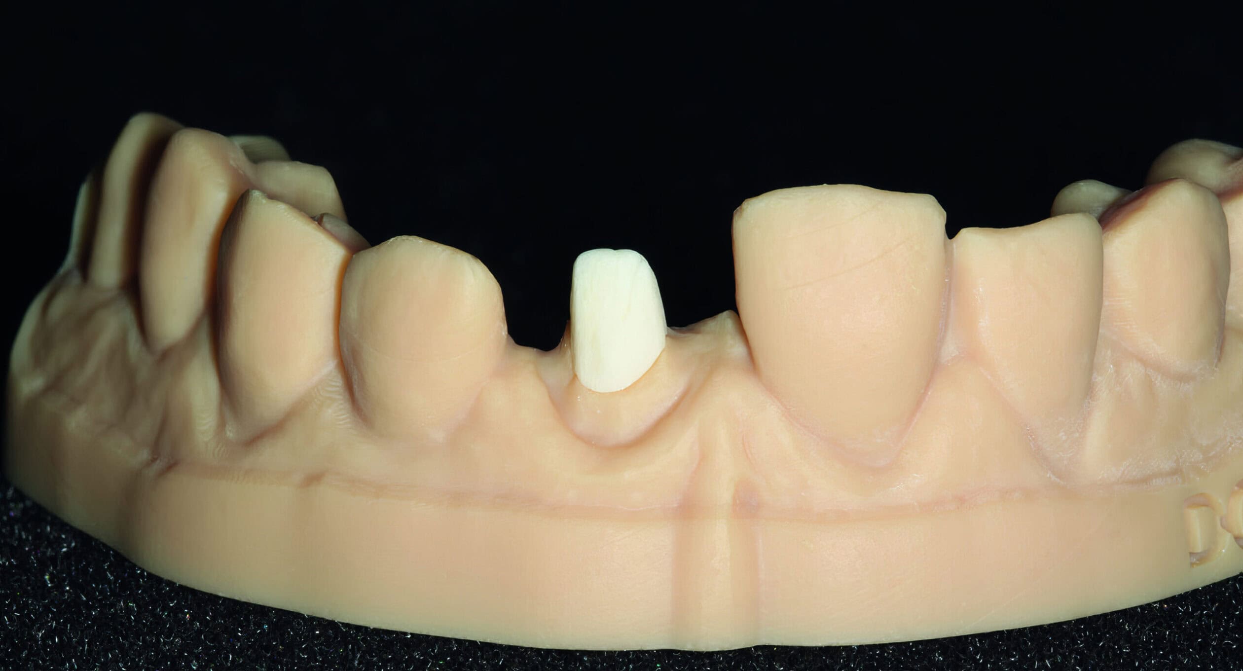 Inlay-core en fibre de verre – Solution innovante pour une restauration dentaire résistante, esthétique et biocompatible 2