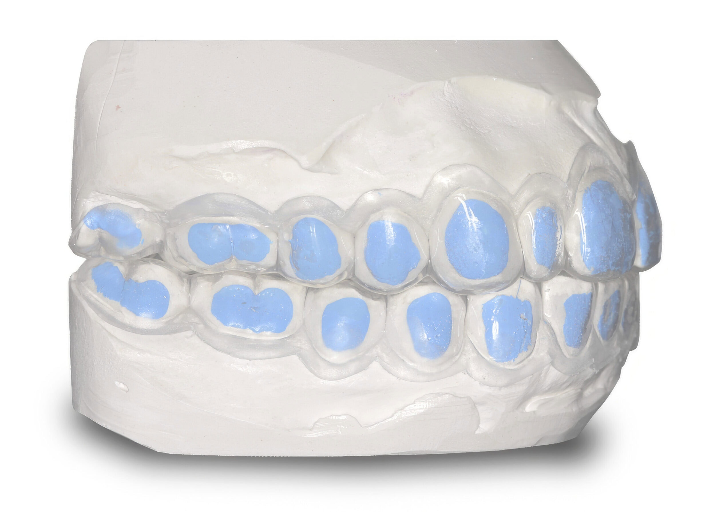 Mascherina sbiancante con serbatoi - Adattamento perfetto per uno sbiancamento uniforme e una fluorizzazione efficace