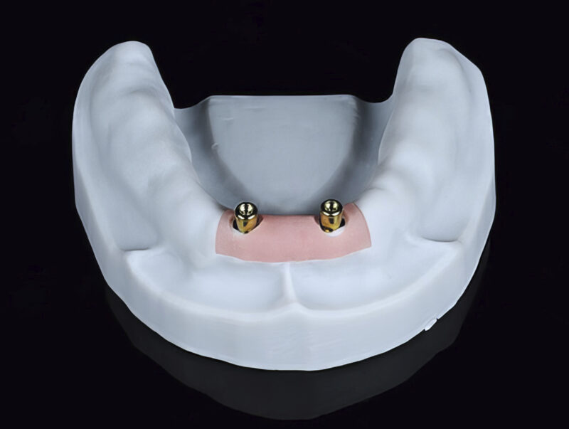 Modèle de travail avec piliers axiaux pour prothèse amovible supra-implantaire