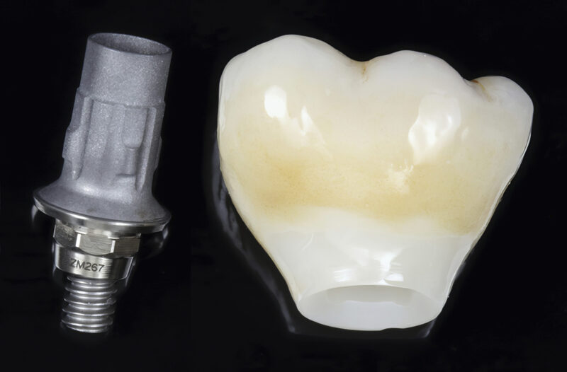 Pilier Ti-base et couronne transvissée – ajustement précis avant assemblage et pose en bouche