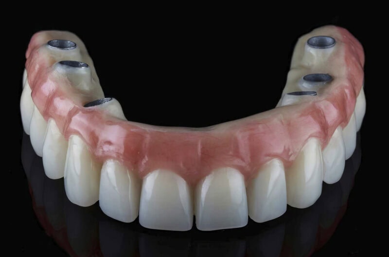 Prothèse complète sur implants All On avec armature titane et cosmétique acrylique