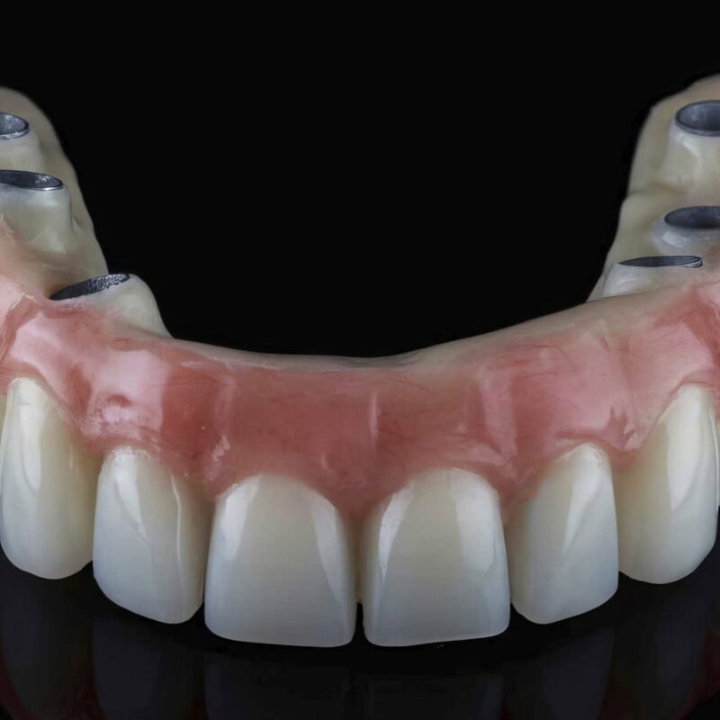 Prothèse complète sur implants All On avec armature titane et cosmétique acrylique